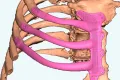 Media Name: rem082_-_cancer_patient_in_south_wales_receives_life-saving_operation_-_image_0.jpg