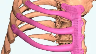 Media Name: rem082_-_cancer_patient_in_south_wales_receives_life-saving_operation_-_image_0.jpg